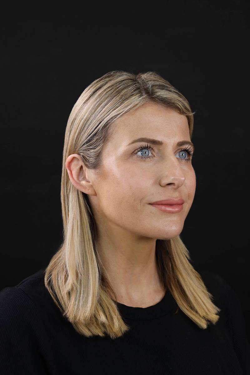 FULL FACE TRANSFORMATION after