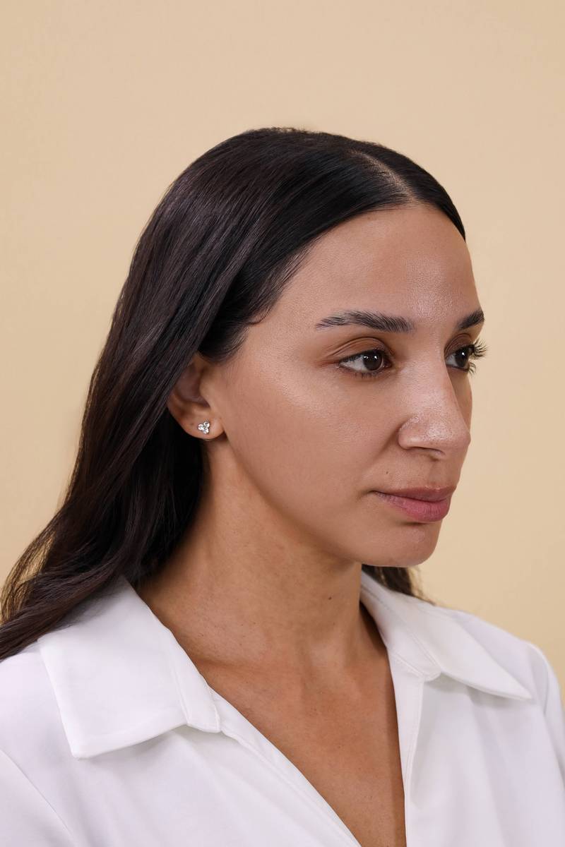 FACE FILLER TREATMENT after