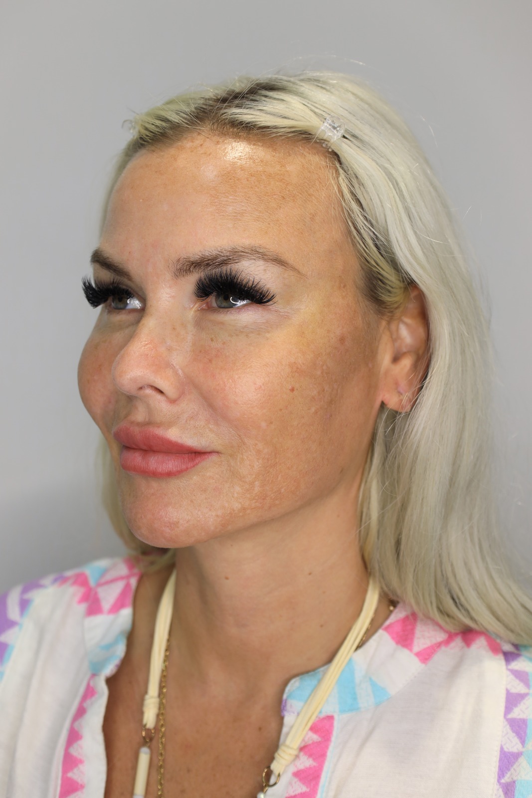 FACE THREAD LIFTING TRANSFORMATION before
