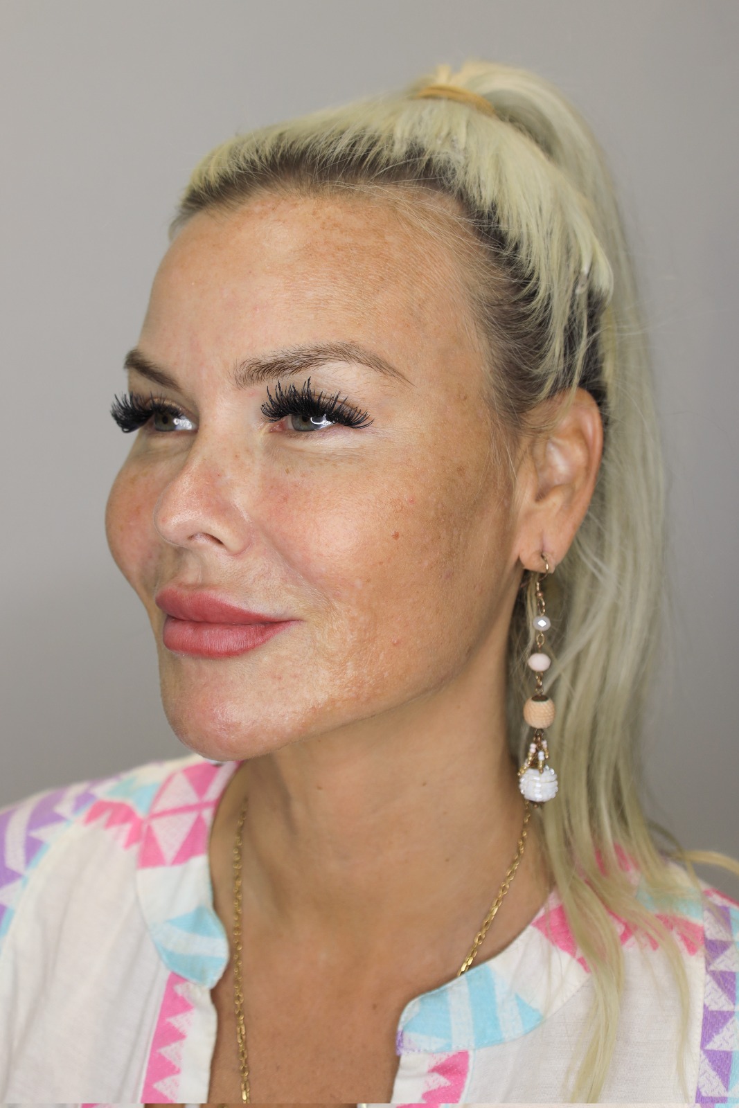 FACE THREAD LIFTING TRANSFORMATION after